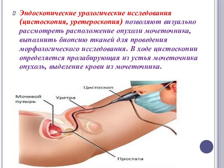 Эндоскопические урологические исследования (цистоскопия, уретероскопия) позволяют визуально рассмотреть расположение опухоли мочеточника, выполнить