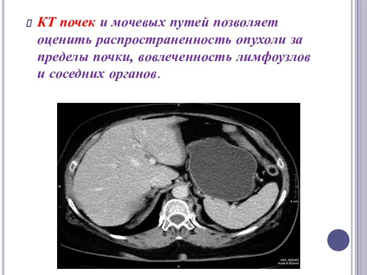 КТ почек и мочевых путей позволяет оценить распространенность опухоли за пределы почки,