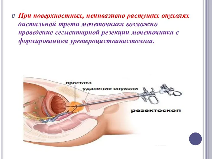 При поверхностных, неинвазивно растущих опухолях дистальной трети мочеточника возможно проведение сегментарной резекции мочеточника с формированием уретероцистоанастомоза.