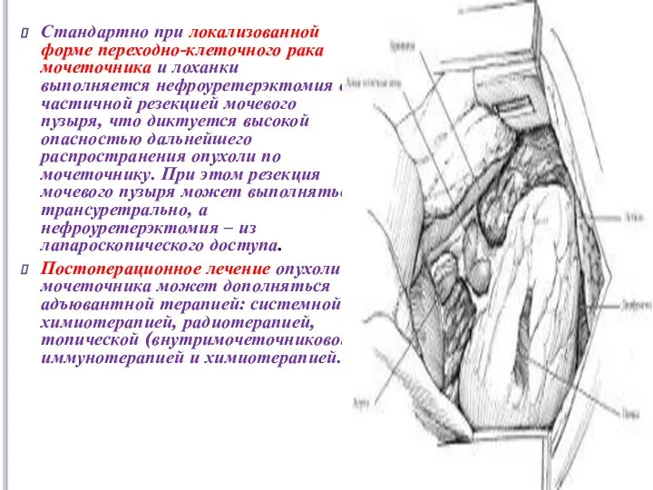 Стандартно при локализованной форме переходно-клеточного рака мочеточника и лоханки выполняется нефроуретерэктомия с