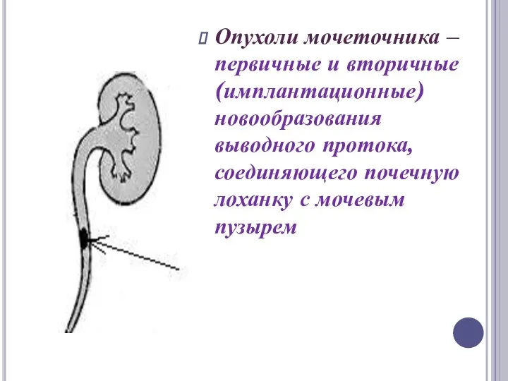 Опухоли мочеточника – первичные и вторичные (имплантационные) новообразования выводного протока, соединяющего почечную лоханку с мочевым пузырем