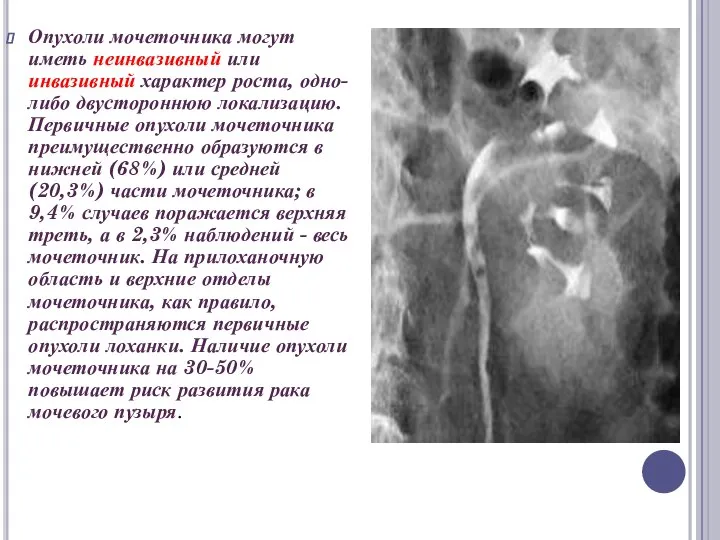 Опухоли мочеточника могут иметь неинвазивный или инвазивный характер роста, одно- либо двустороннюю