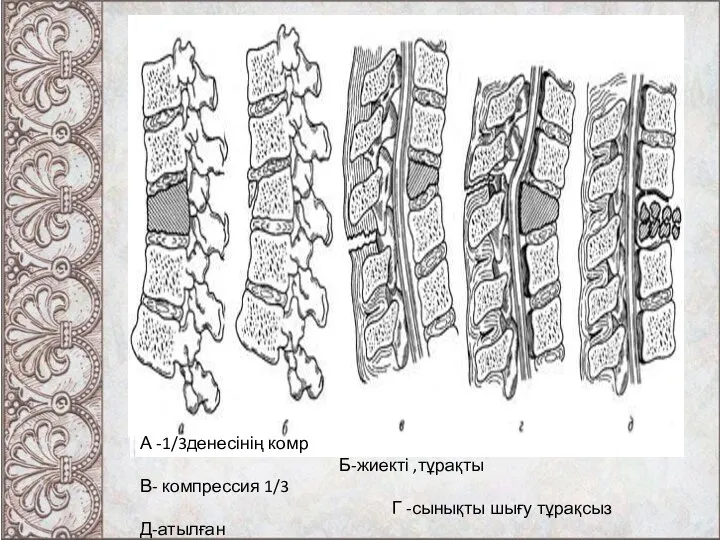 А -1/3денесінің комр Б-жиекті ,тұрақты В- компрессия 1/3 Г -сынықты шығу тұрақсыз Д-атылған