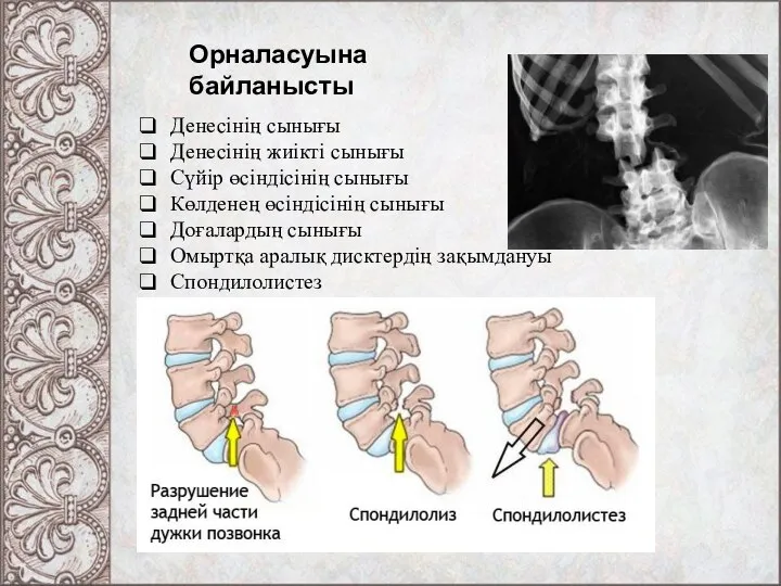 Орналасуына байланысты Денесінің сынығы Денесінің жиікті сынығы Сүйір өсіндісінің сынығы Көлденең өсіндісінің