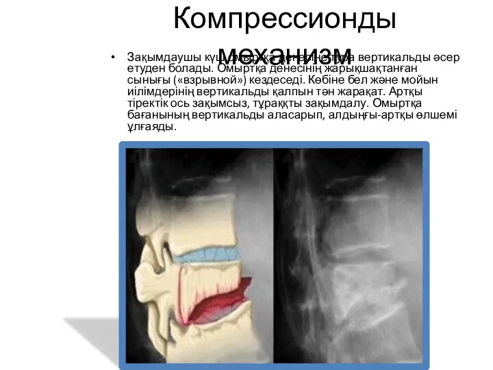 Компрессионды механизм Зақымдаушы күш омыртқа денесіне тура вертикальды әсер етуден болады. Омыртқа