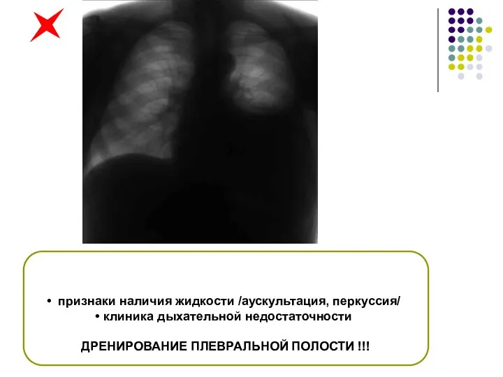 признаки наличия жидкости /аускультация, перкуссия/ клиника дыхательной недостаточности ДРЕНИРОВАНИЕ ПЛЕВРАЛЬНОЙ ПОЛОСТИ !!!