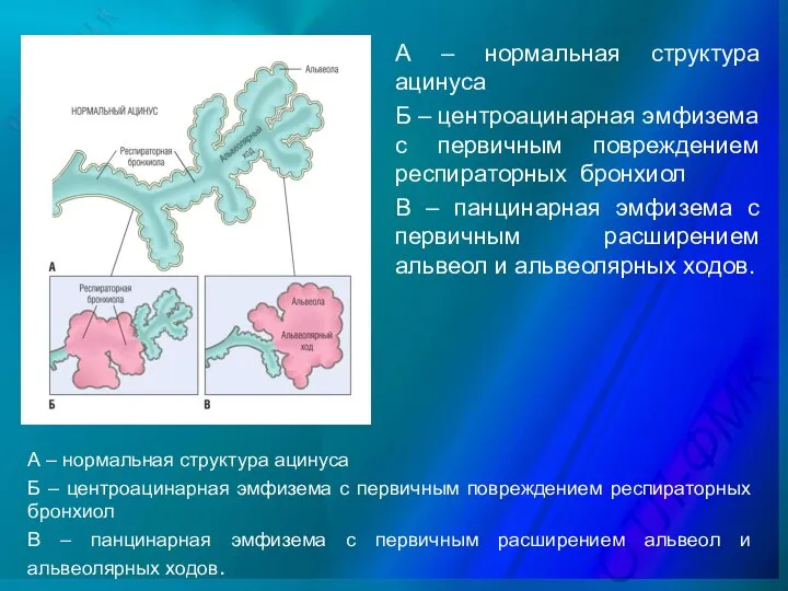 А – нормальная структура ацинуса Б – центроацинарная эмфизема с первичным повреждением