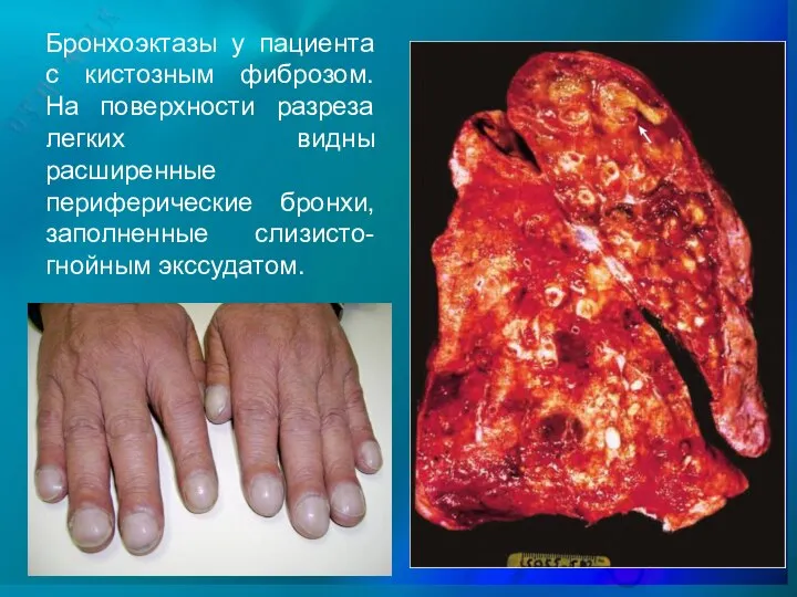 Бронхоэктазы у пациента с кистозным фиброзом. На поверхности разреза легких видны расширенные