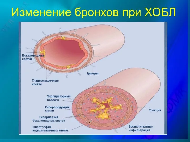 Изменение бронхов при ХОБЛ