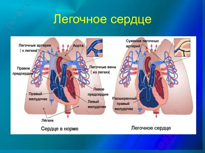 Легочное сердце