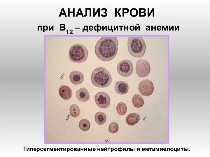 АНАЛИЗ КРОВИ при В12 – дефицитной анемии Гиперсегментированные нейтрофилы и метамиелоциты.