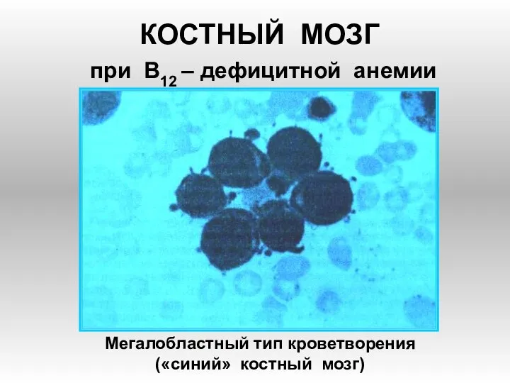 КОСТНЫЙ МОЗГ при В12 – дефицитной анемии Мегалобластный тип кроветворения («синий» костный мозг)