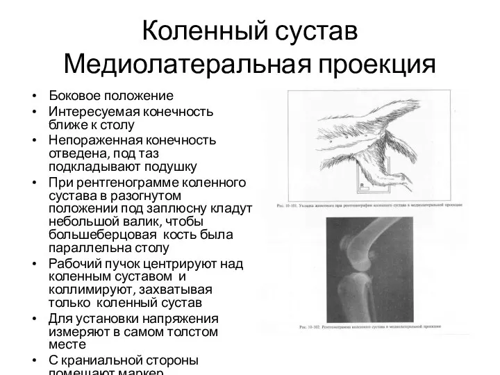 Коленный сустав Медиолатеральная проекция Боковое положение Интересуемая конечность ближе к столу Непораженная