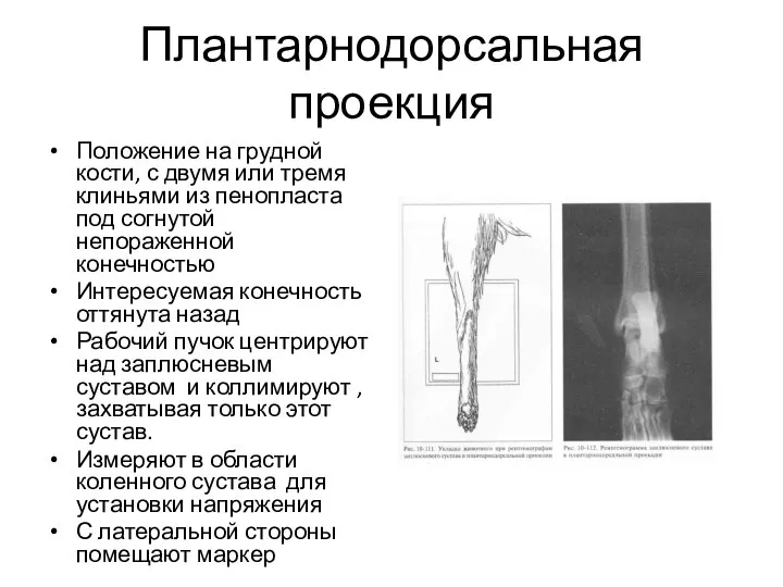 Плантарнодорсальная проекция Положение на грудной кости, с двумя или тремя клиньями из