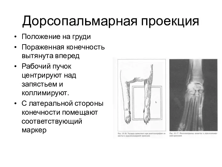 Дорсопальмарная проекция Положение на груди Пораженная конечность вытянута вперед Рабочий пучок центрируют