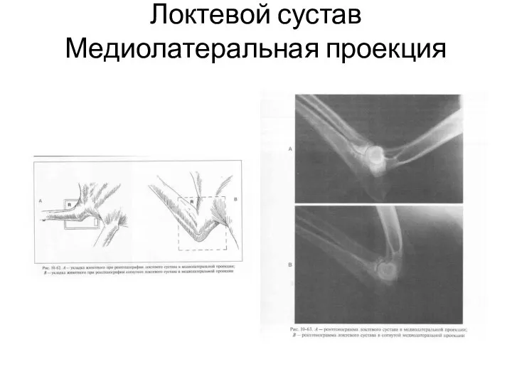 Локтевой сустав Медиолатеральная проекция