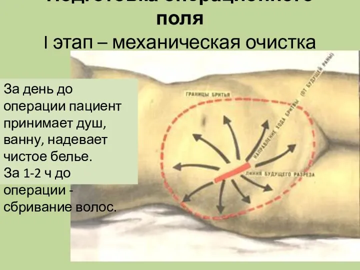 Подготовка операционного поля I этап – механическая очистка кожи За день до