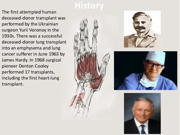 History The first attempted human deceased-donor transplant was performed by the Ukrainian