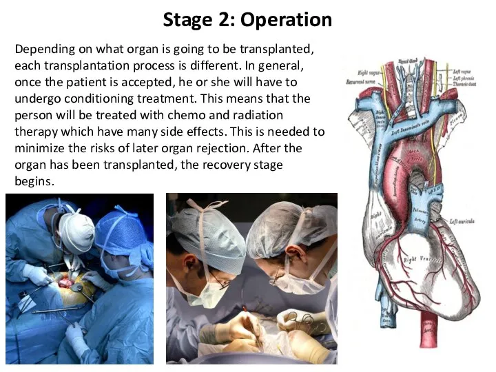 Stage 2: Operation Depending on what organ is going to be transplanted,