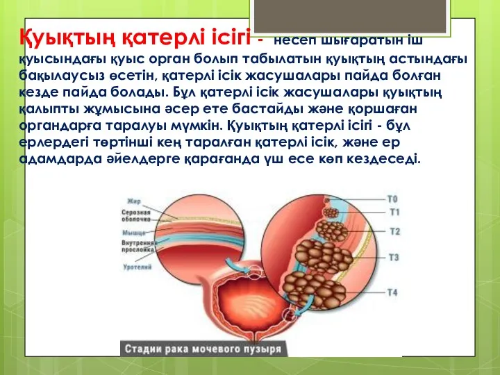 Қуықтың қатерлі ісігі - несеп шығаратын іш қуысындағы қуыс орган болып табылатын