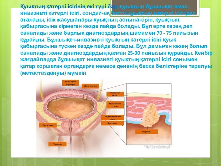 Қуықтың қатерлі ісігінің екі түрі бар: қуықтың бұлшықет емес-инвазивті қатерлі ісігі, сондай-ақ