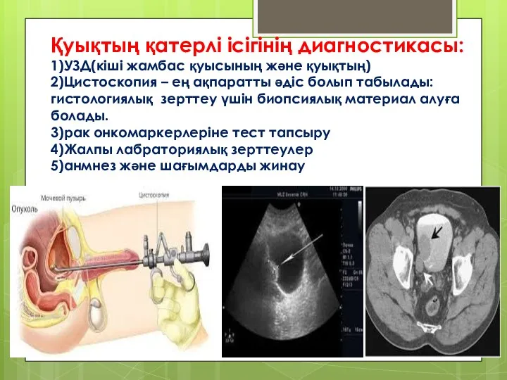 Қуықтың қатерлі ісігінің диагностикасы: 1)УЗД(кіші жамбас қуысының және қуықтың) 2)Цистоскопия – ең