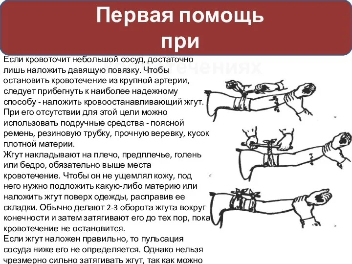 Первая помощь при кровотечениях Если кровоточит небольшой сосуд, достаточно лишь наложить давящую