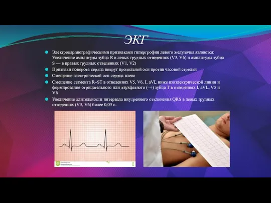 ЭКГ Электрокардиографическими признаками гипертрофии левого желудочка являются: Увеличение амплитуды зубца R в