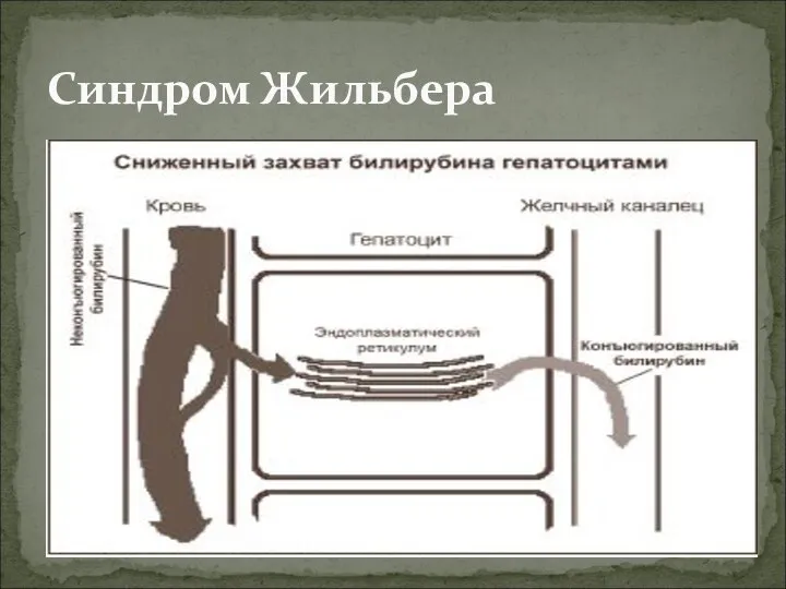 Синдром Жильбера