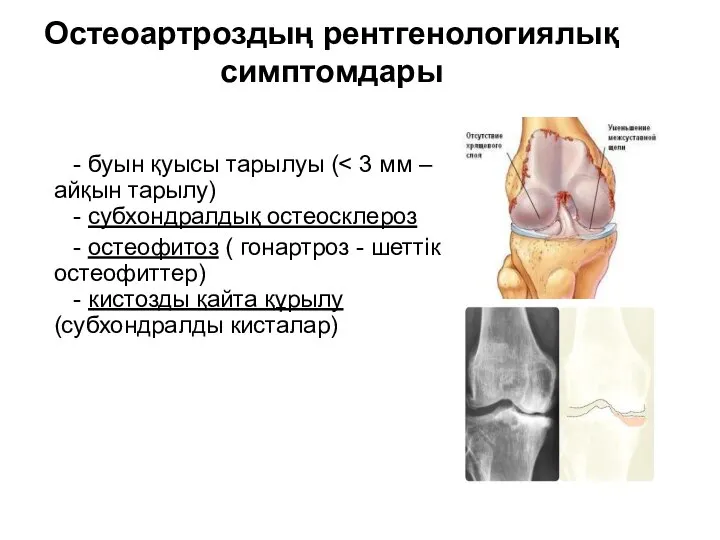 - буын қуысы тарылуы ( - остеофитоз ( гонартроз - шеттік остеофиттер)