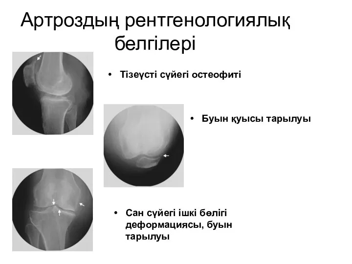 Артроздың рентгенологиялық белгілері Тізеүсті сүйегі остеофиті Буын қуысы тарылуы Сан сүйегі ішкі бөлігі деформациясы, буын тарылуы