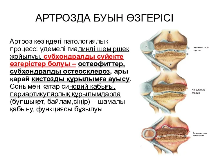 АРТРОЗДА БУЫН ӨЗГЕРІСІ Артроз кезіндегі патологиялық процесс: үдемелі гиалинді шеміршек жойылуы, субхондралды