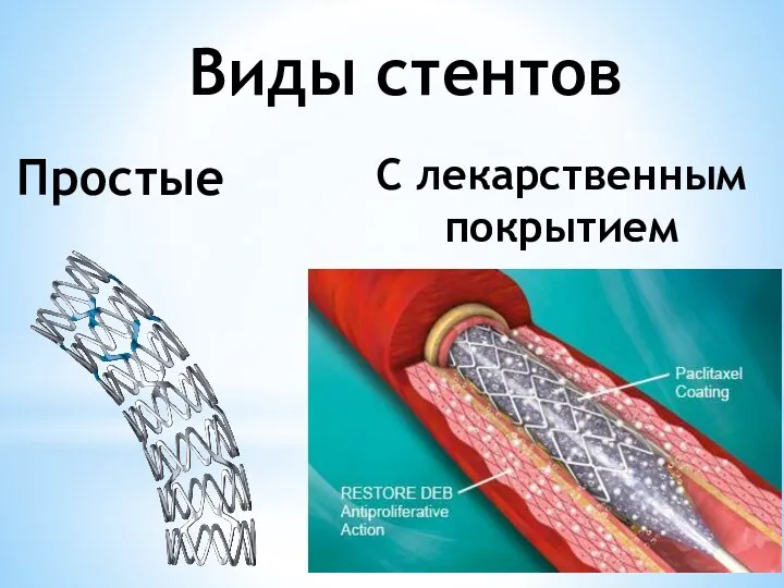 Виды стентов Простые С лекарственным покрытием