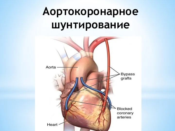 Аортокоронарное шунтирование