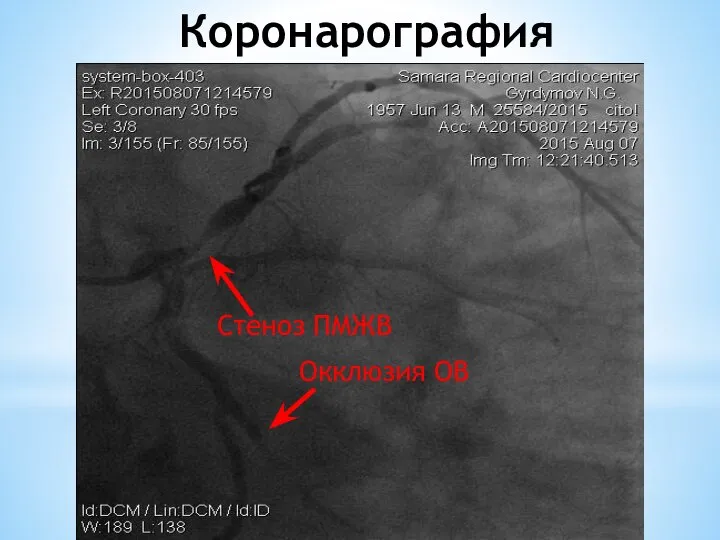 Коронарография Стеноз ПМЖВ Окклюзия ОВ