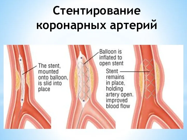 Стентирование коронарных артерий