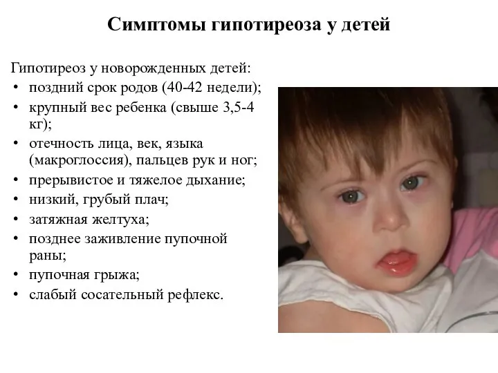 Симптомы гипотиреоза у детей Гипотиреоз у новорожденных детей: поздний срок родов (40-42