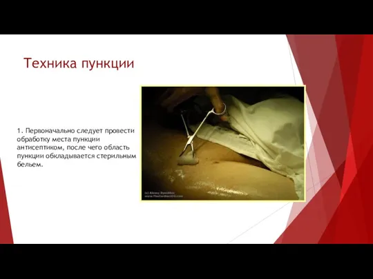 Техника пункции 1. Первоначально следует провести обработку места пункции антисептиком, после чего