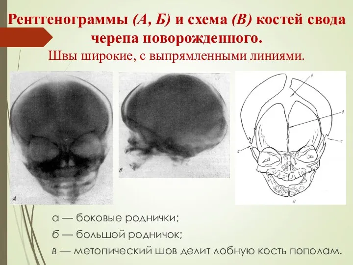 Рентгенограммы (А, Б) и схема (В) костей свода черепа новорожденного. Швы широкие,
