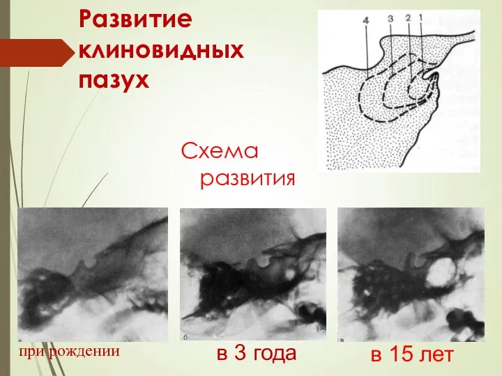 Развитие клиновидных пазух при рождении в 15 лет в 3 года Схема развития