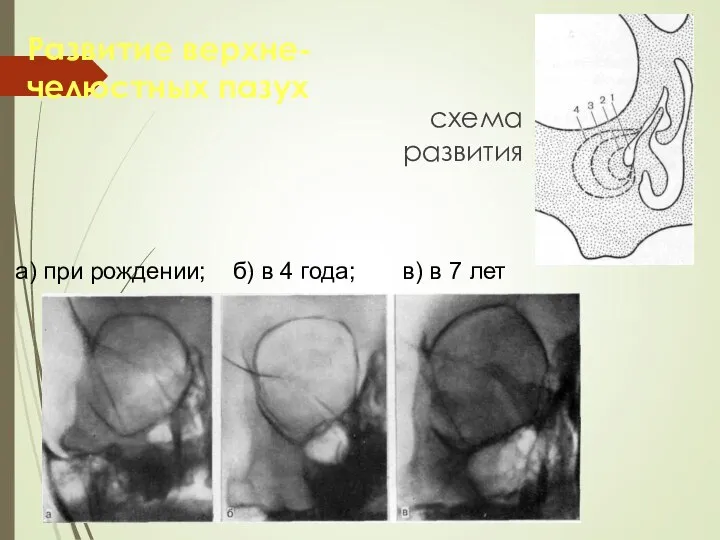 Развитие верхне-челюстных пазух схема развития а) при рождении; б) в 4 года; в) в 7 лет