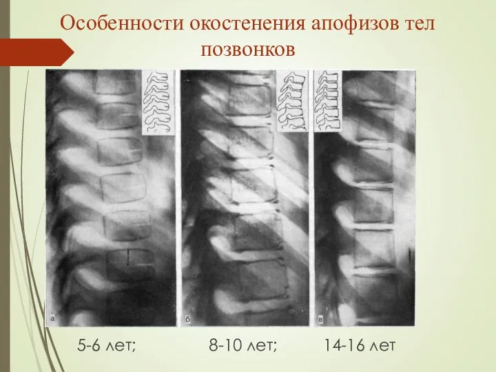 Особенности окостенения апофизов тел позвонков 5-6 лет; 8-10 лет; 14-16 лет