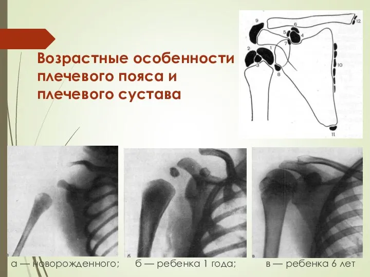 Возрастные особенности плечевого пояса и плечевого сустава а — новорожденного; б —