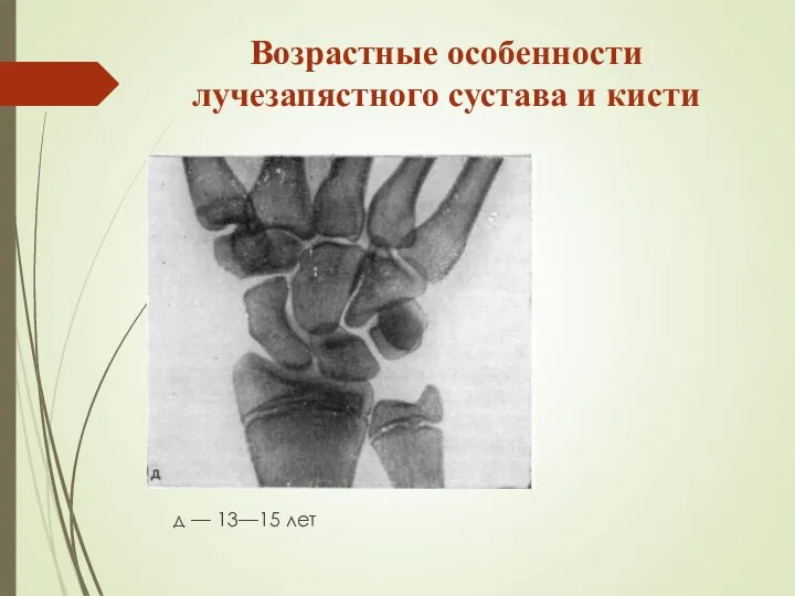 Возрастные особенности лучезапястного сустава и кисти д — 13—15 лет