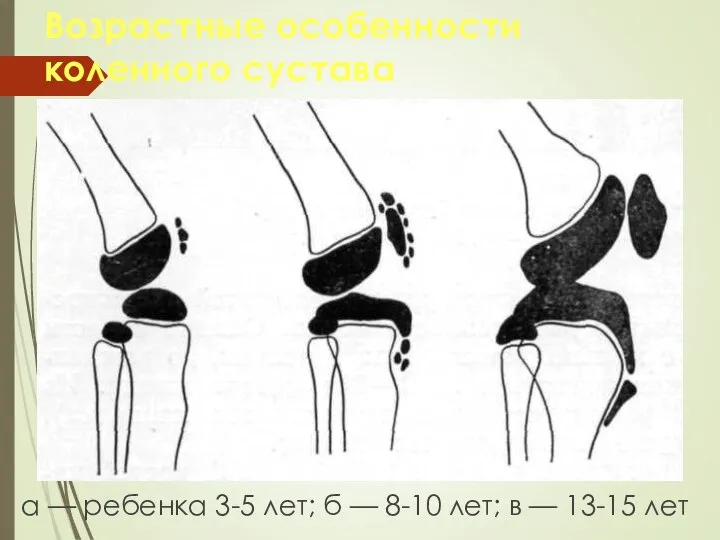 Возрастные особенности коленного сустава а — ребенка 3-5 лет; б — 8-10