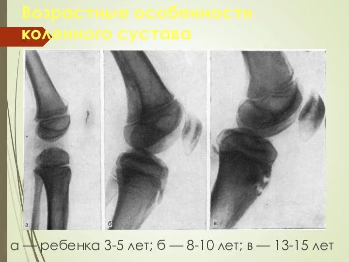 Возрастные особенности коленного сустава а — ребенка 3-5 лет; б — 8-10