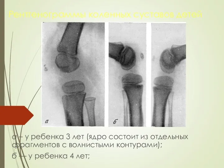 Рентгенограммы коленных суставов детей а – у ребенка 3 лет (ядро состоит