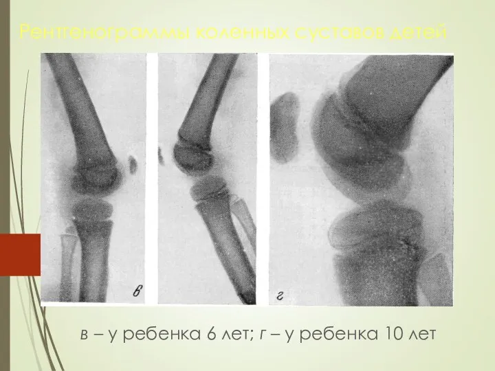 Рентгенограммы коленных суставов детей в – у ребенка 6 лет; г – у ребенка 10 лет