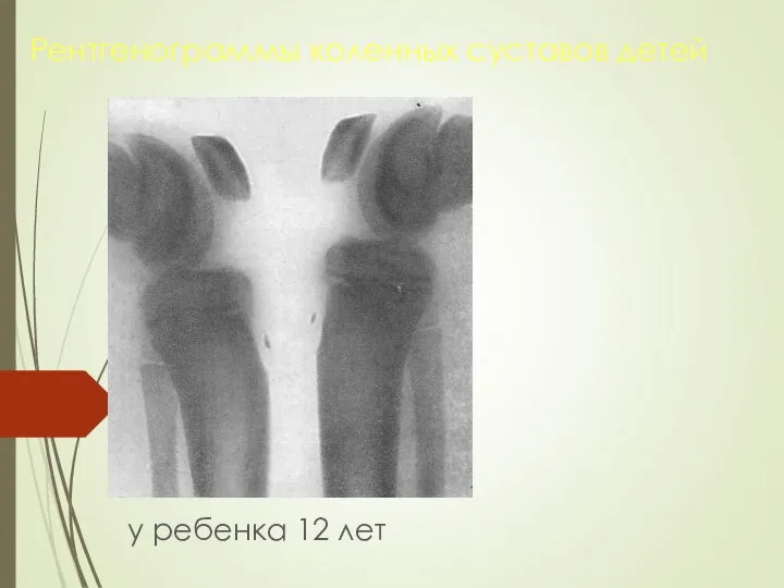 Рентгенограммы коленных суставов детей у ребенка 12 лет