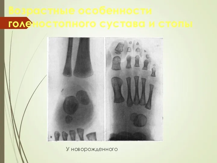 Возрастные особенности голеностопного сустава и стопы У новорожденного